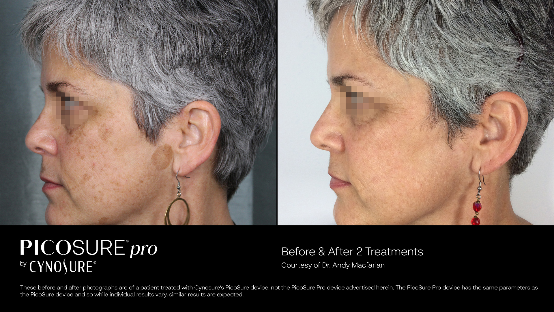 PicoSure Pro treatment results showing improved skin clarity at Beauty Glam Studio in Boca Raton, FL.