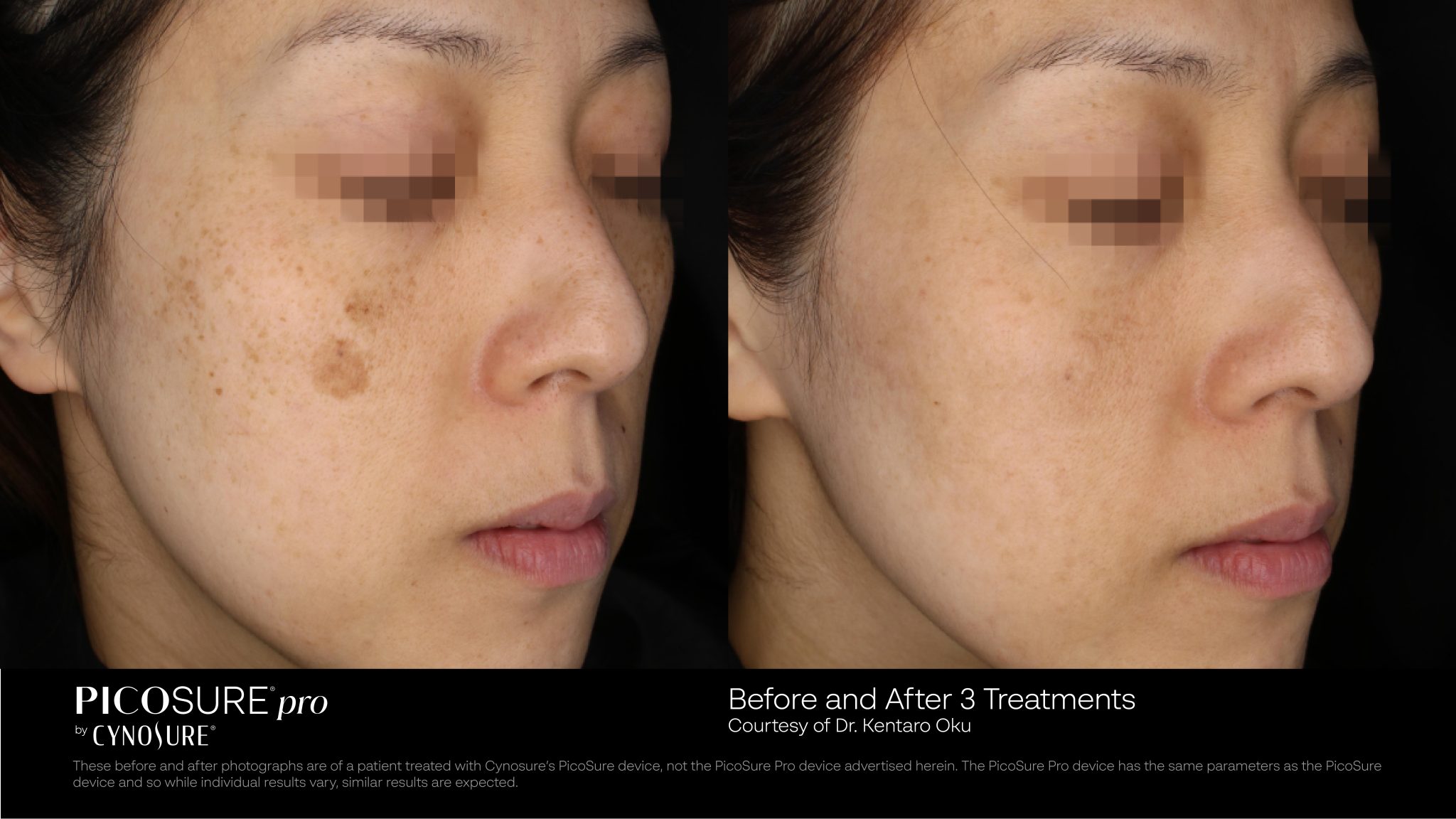 Before and after PicoSure Pro laser treatment showing brighter skin.