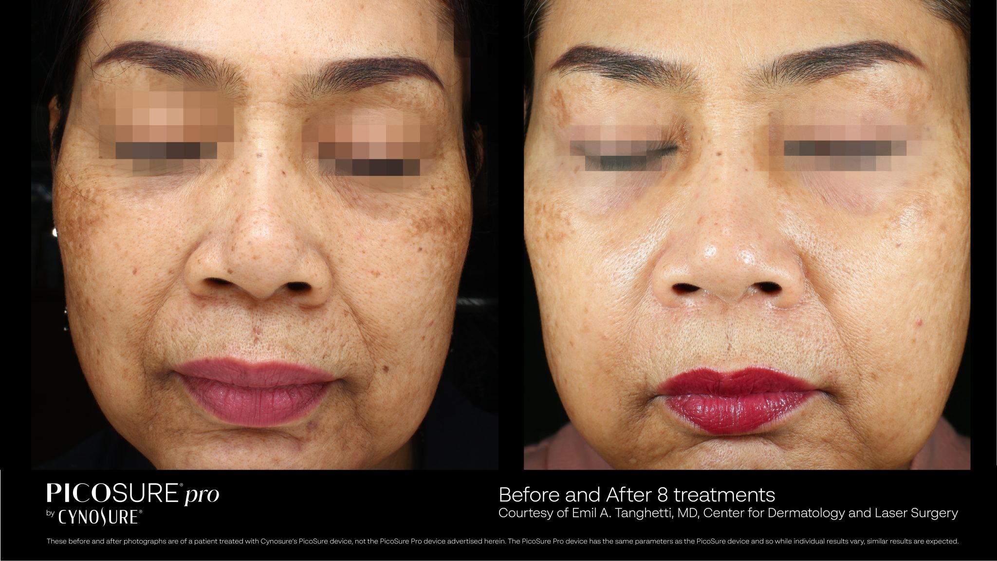 PicoSure Pro treatment supporting even, radiant skin.