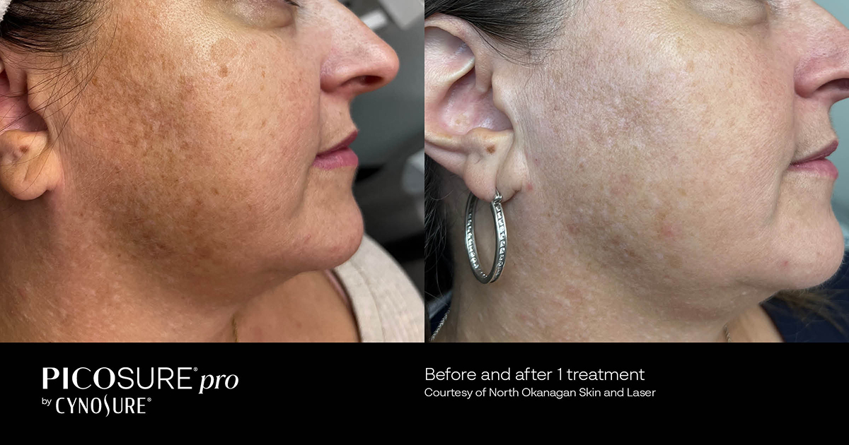 Clearer skin achieved after PicoSure Pro treatment.