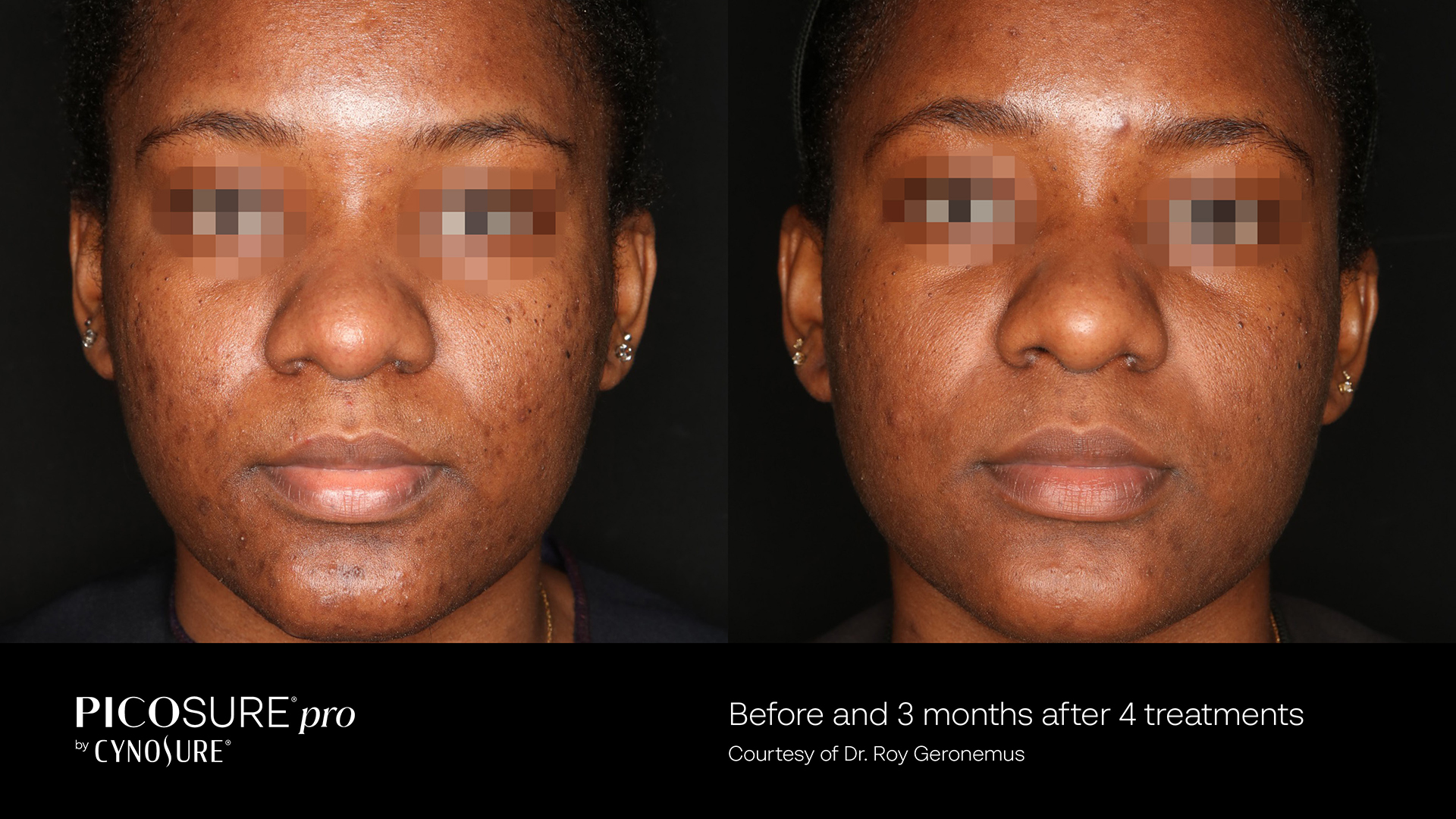 Skin improvement following PicoSure Pro laser therapy in Boca Raton, FL.