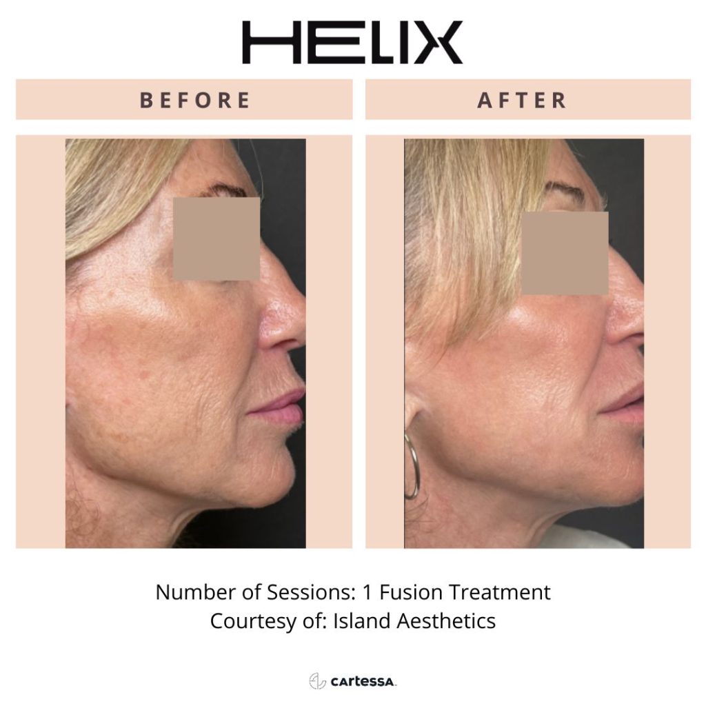 Before and after Helix laser treatment showing improved skin texture and tone at Beauty Glam Studio in Florida.