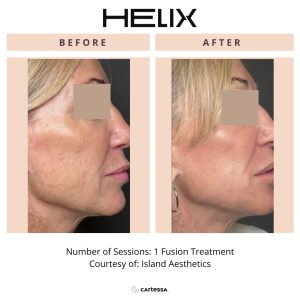 Before and after Helix laser treatment showing improved skin texture and tone at Beauty Glam Studio in Florida.