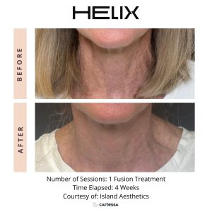Before and after Helix laser therapy highlighting visible skin improvement at Beauty Glam Studio in Florida.