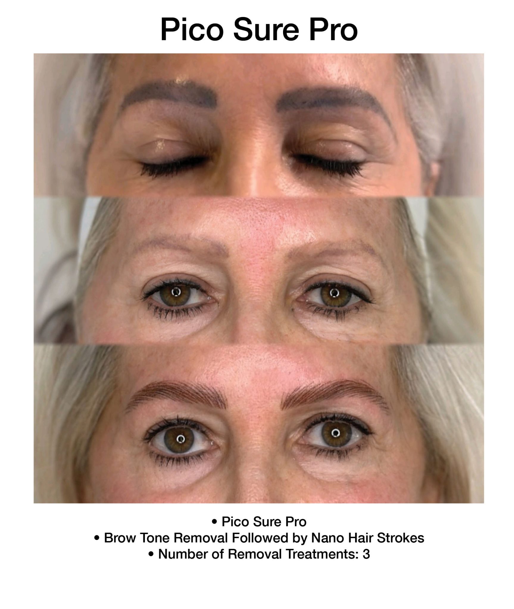 PicoSure Pro treatment enhancing smoother skin tone.