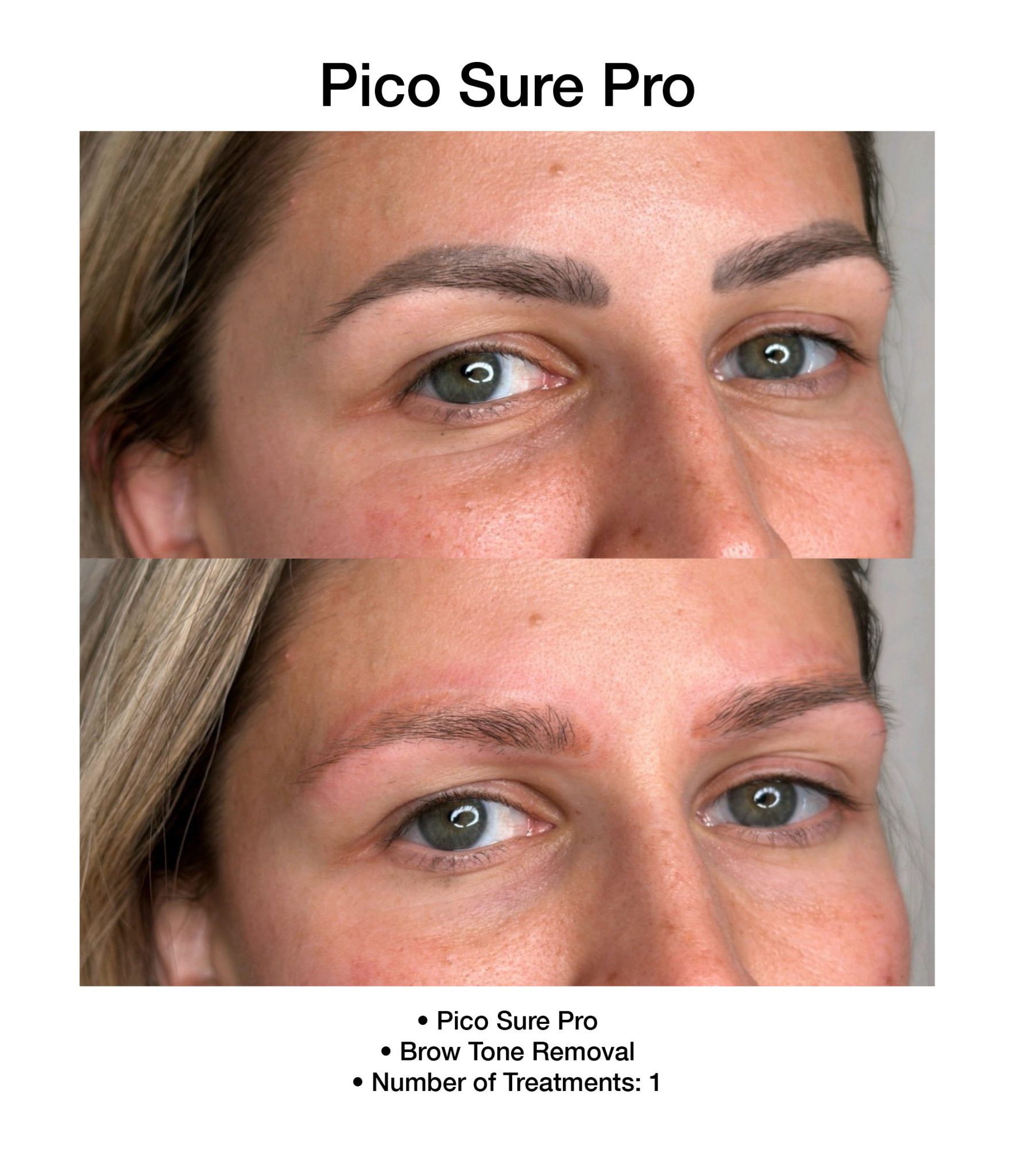 PicoSure Pro laser treatment reducing visible discoloration.