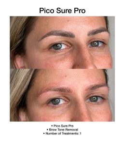 PicoSure Pro laser treatment reducing visible discoloration.