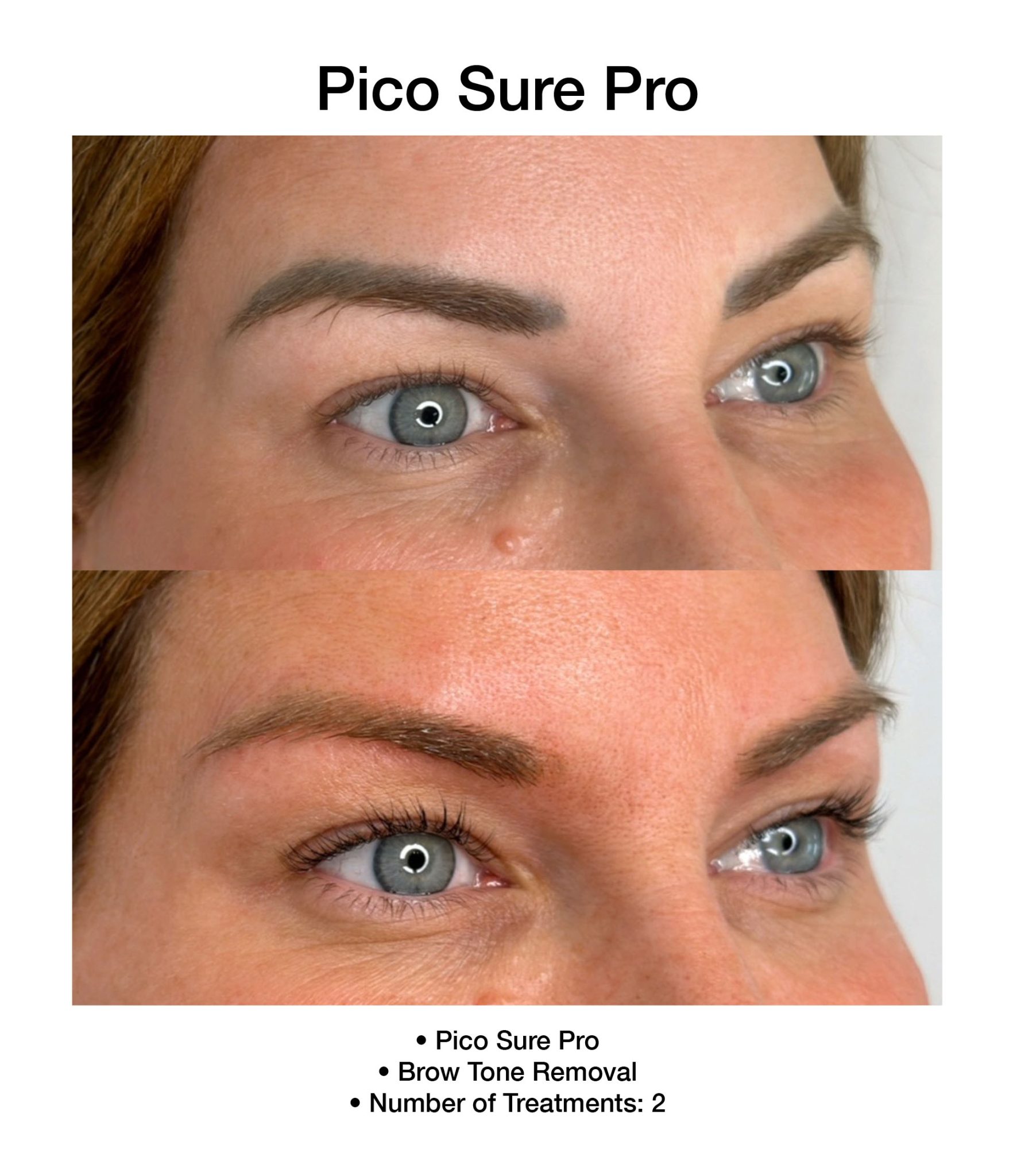 Skin brightening results following PicoSure Pro session.