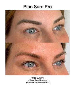 Skin brightening results following PicoSure Pro session.