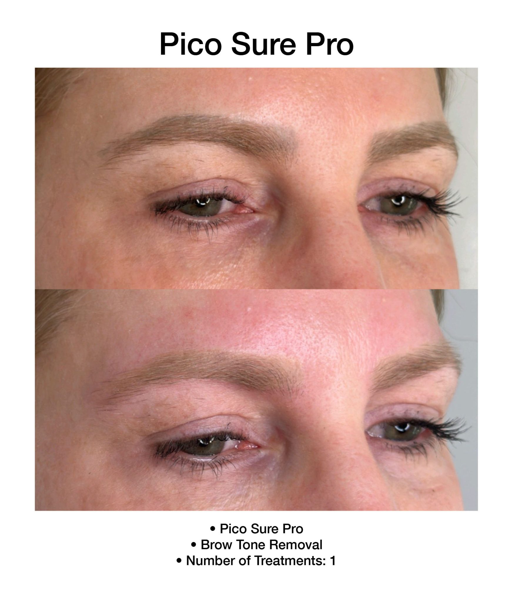 PicoSure Pro treatment improving uneven skin tone.