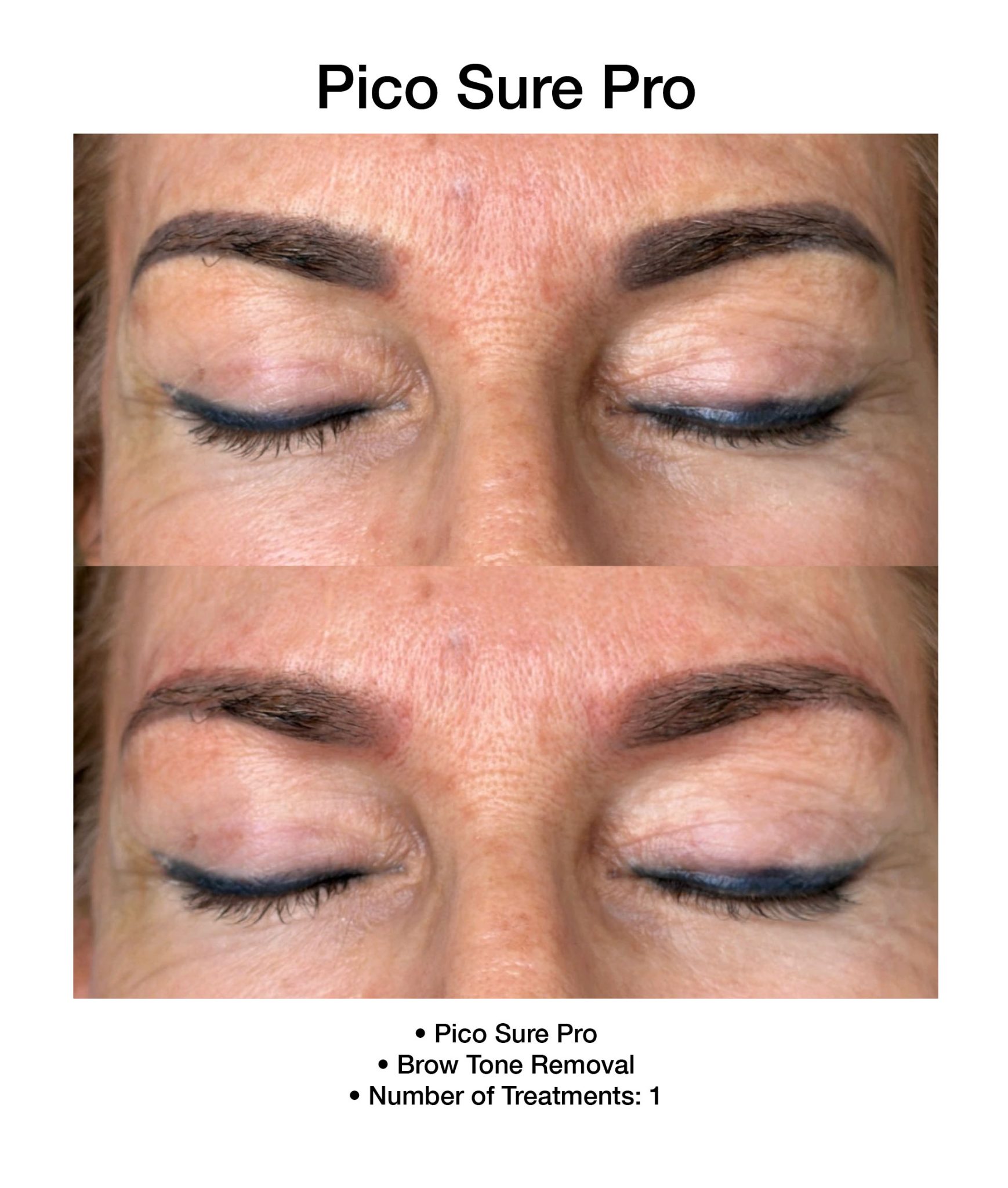 Side-by-side PicoSure Pro results showing reduced dark spots.