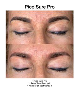 Side-by-side PicoSure Pro results showing reduced dark spots.