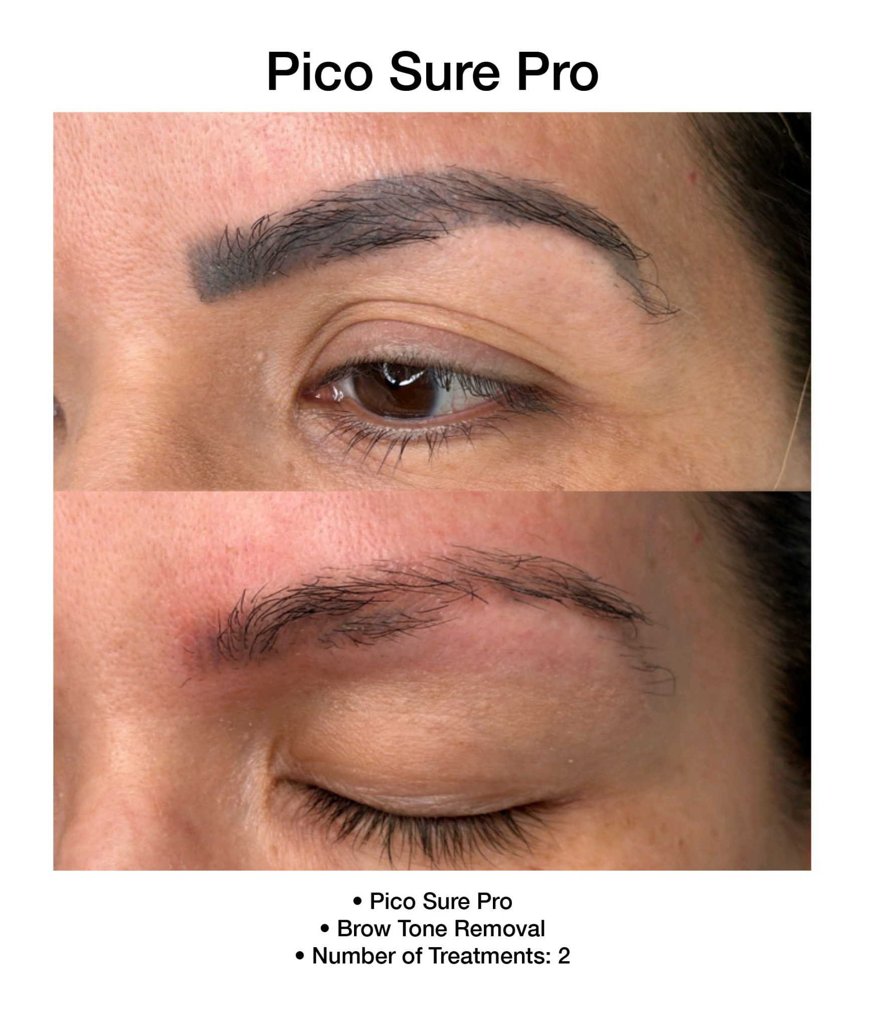 Before and after PicoSure Pro laser treatment for pigmentation.