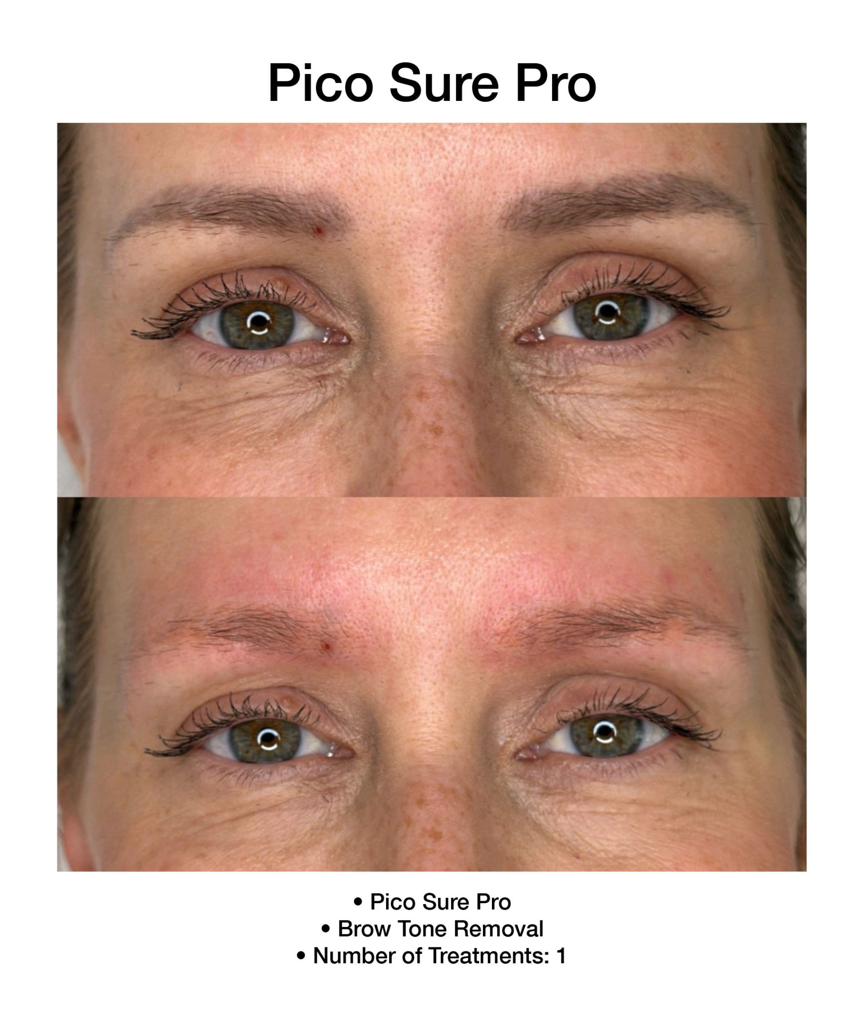 Refreshed skin appearance after PicoSure Pro treatment.