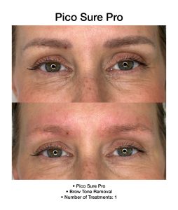 Refreshed skin appearance after PicoSure Pro treatment.