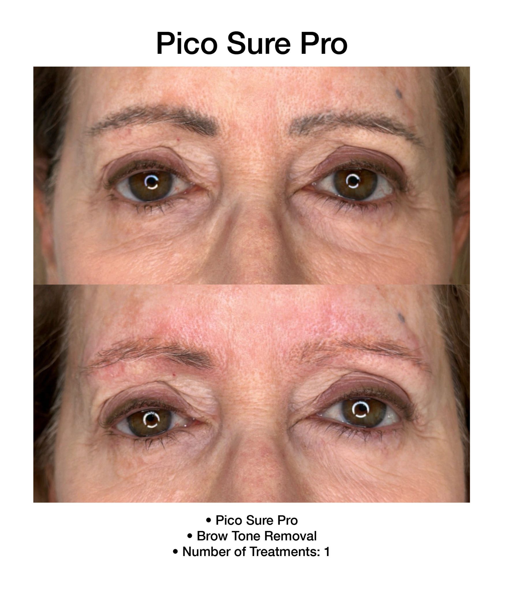 Laser skin correction using PicoSure Pro technology.
