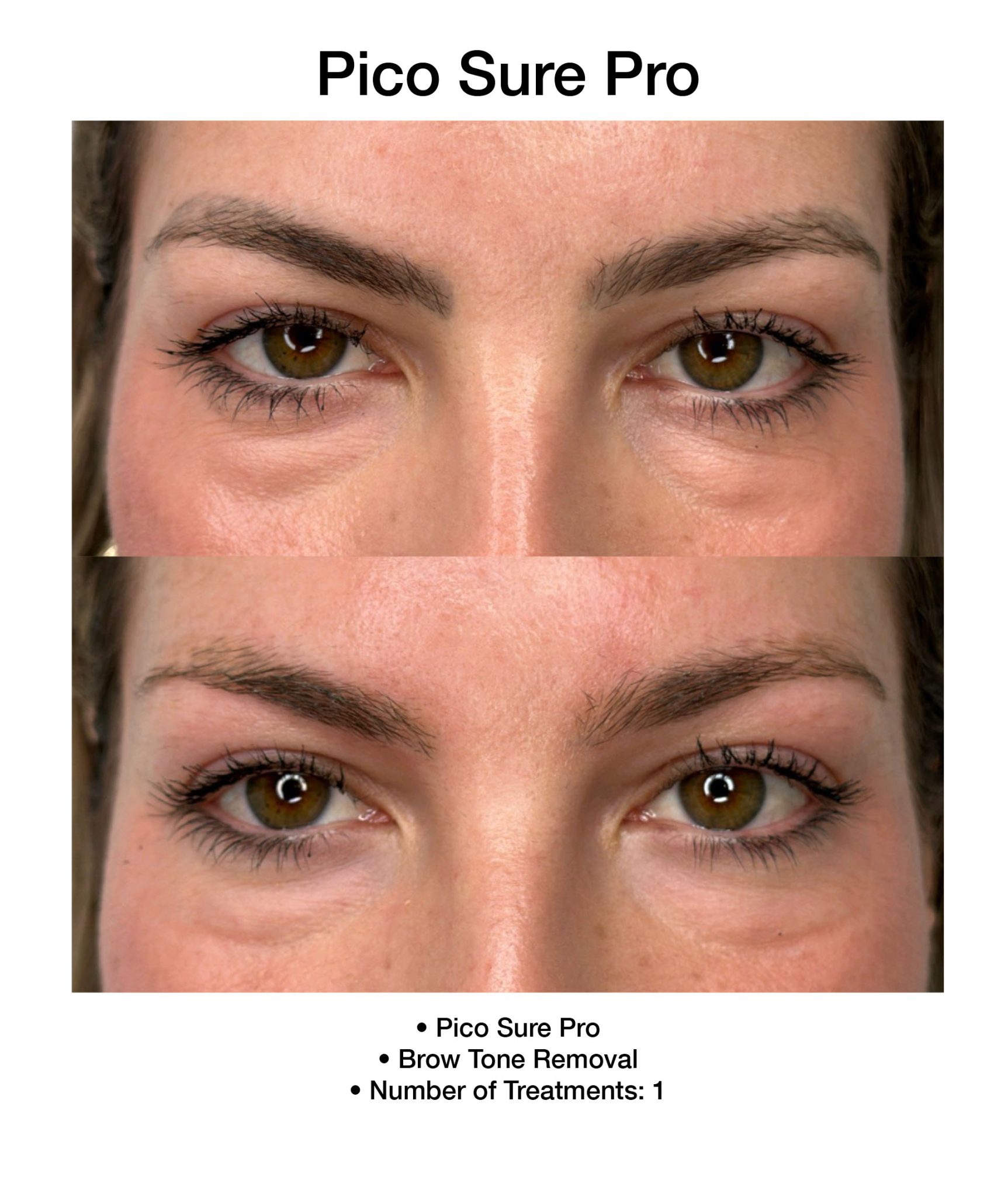 PicoSure Pro treatment enhancing overall skin tone.