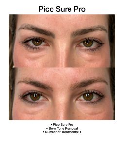 PicoSure Pro treatment enhancing overall skin tone.