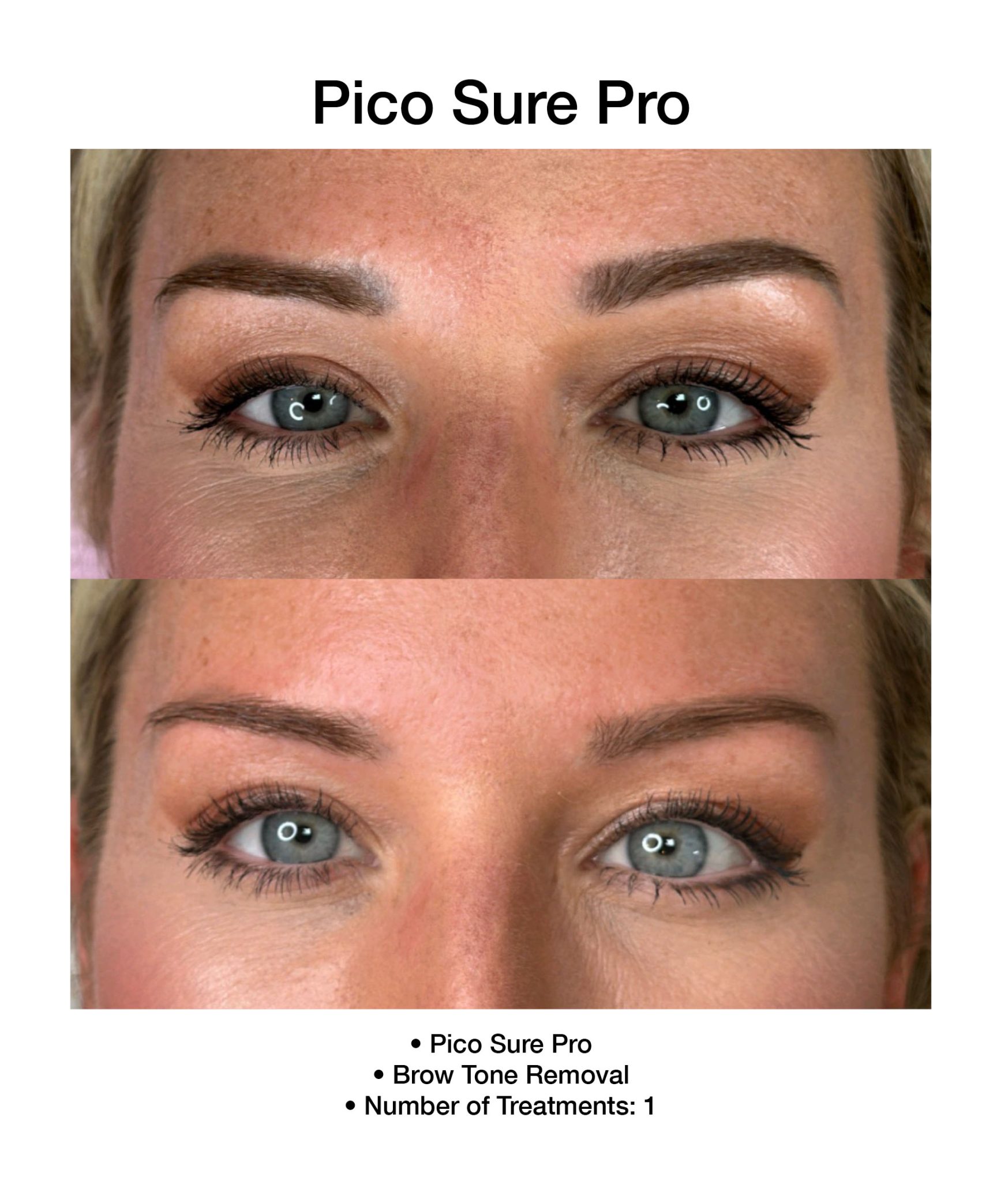 Clearer complexion following PicoSure Pro session.
