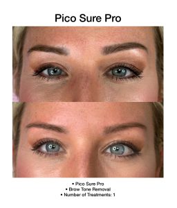 Clearer complexion following PicoSure Pro session.