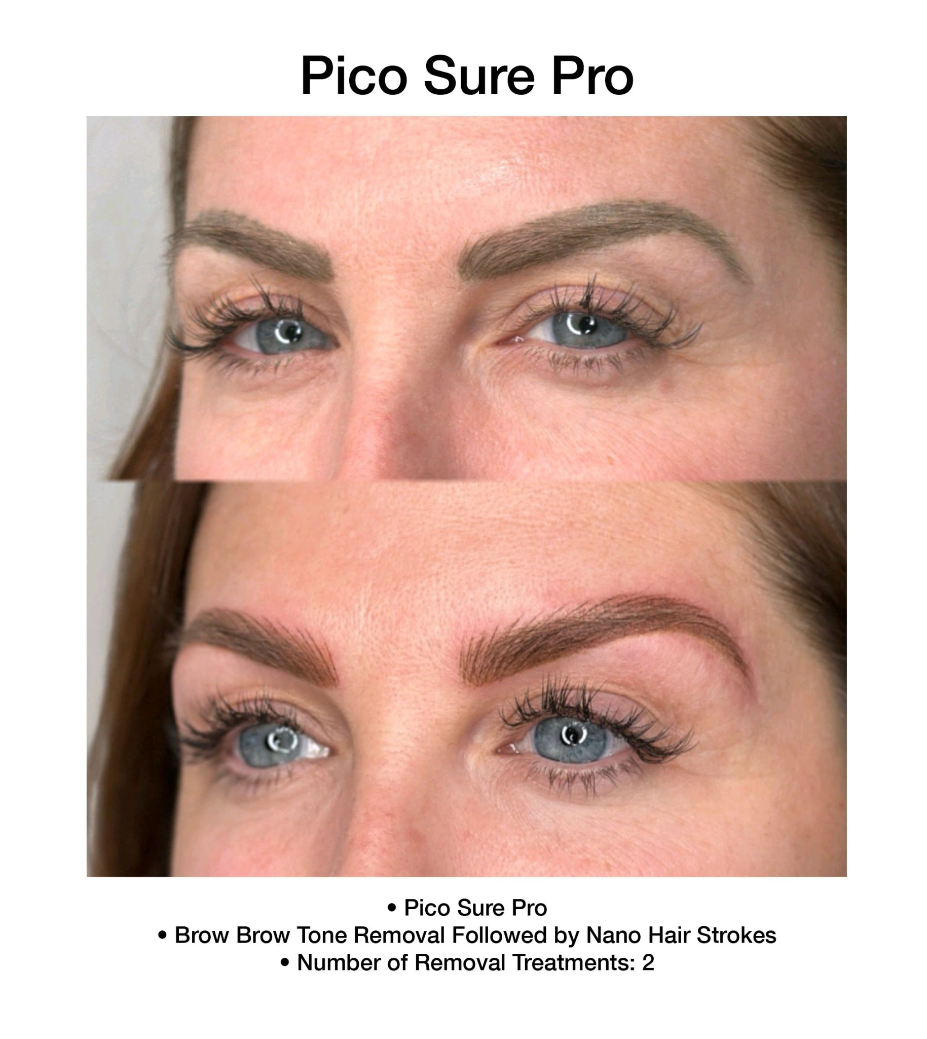 Laser skin treatment results from PicoSure Pro in Boca Raton, FL.