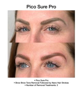 Laser skin treatment results from PicoSure Pro in Boca Raton, FL.