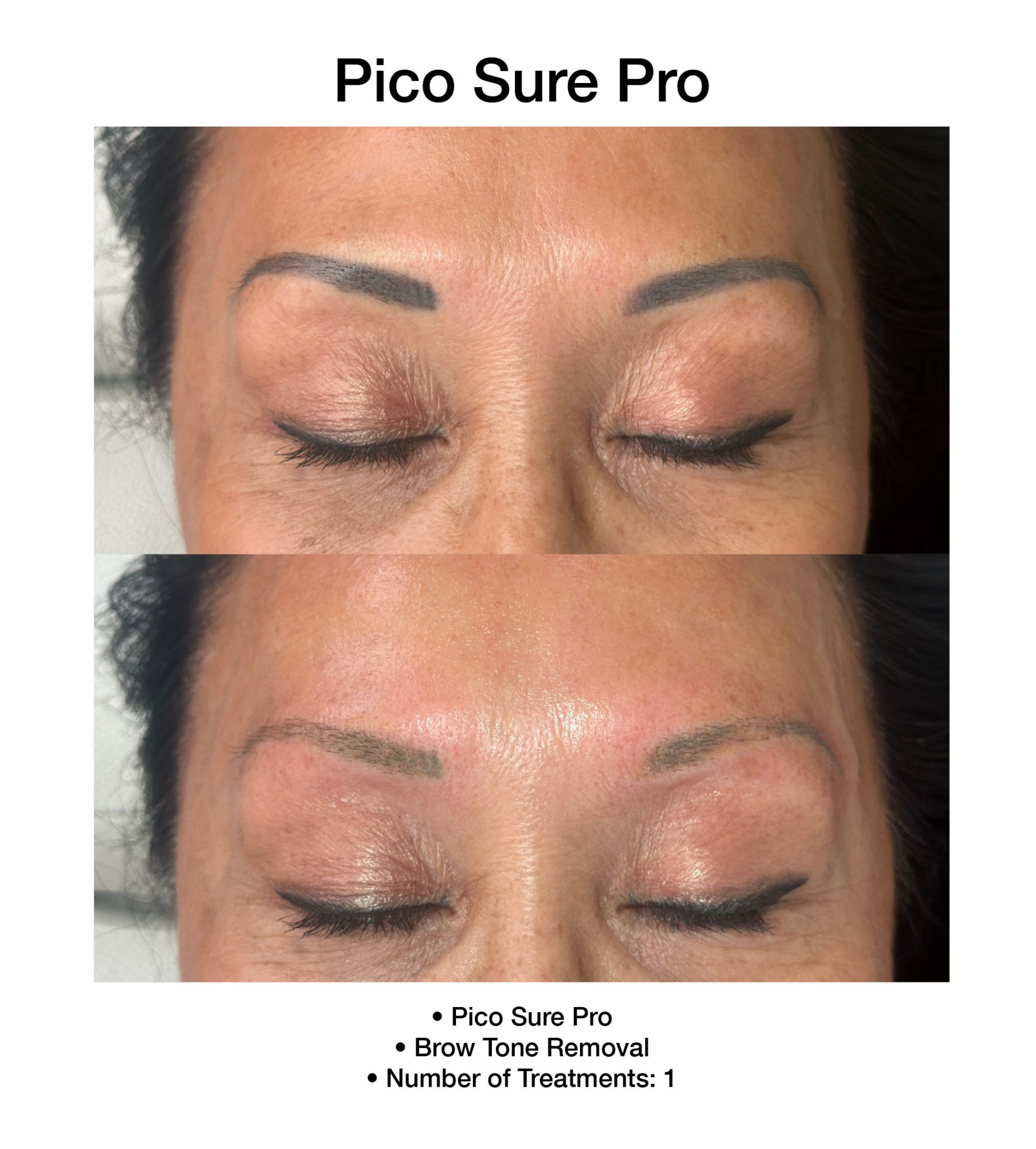 PicoSure Pro results improving overall skin appearance.