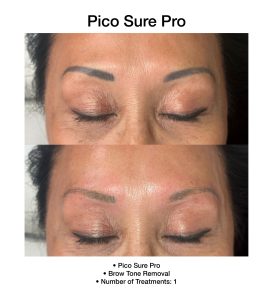 PicoSure Pro results improving overall skin appearance.