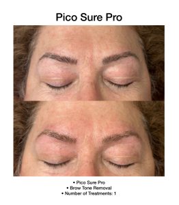 Visible skin correction after PicoSure Pro session.
