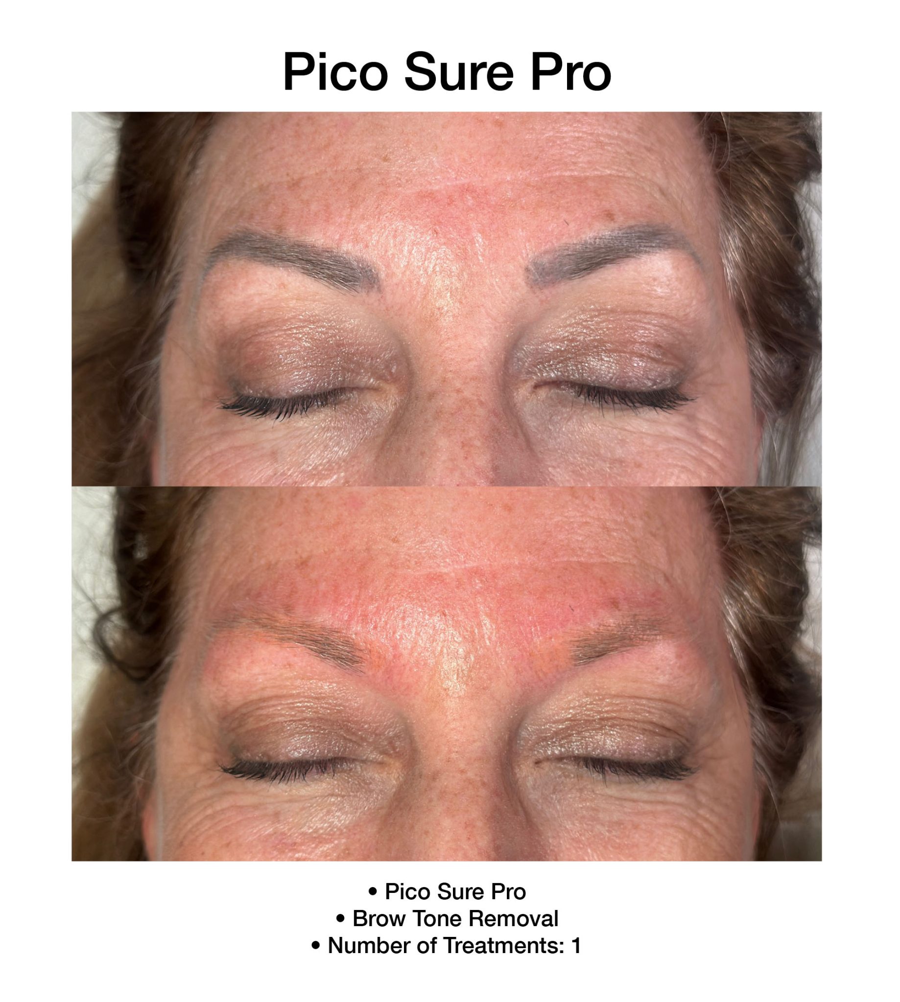 PicoSure Pro treatment reducing signs of sun exposure.