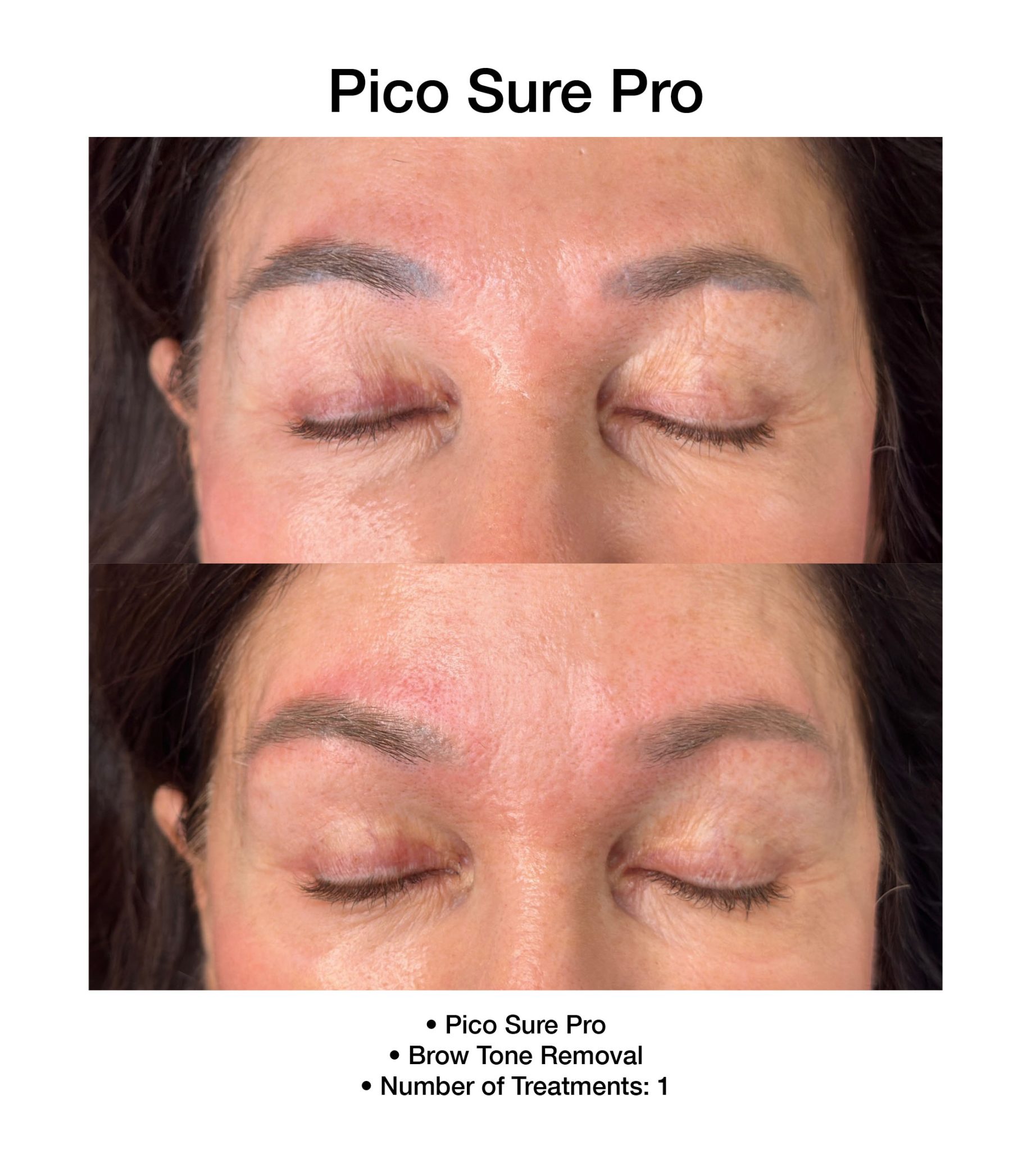 Skin rejuvenation achieved with PicoSure Pro laser technology.