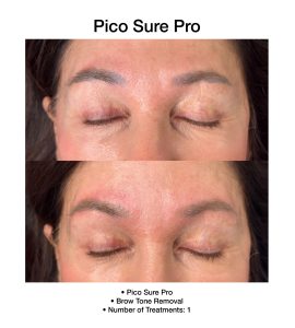 Skin rejuvenation achieved with PicoSure Pro laser technology.