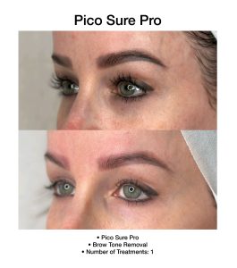 PicoSure Pro enhancing smoother, more even skin.