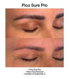 Laser resurfacing results achieved with PicoSure Pro.