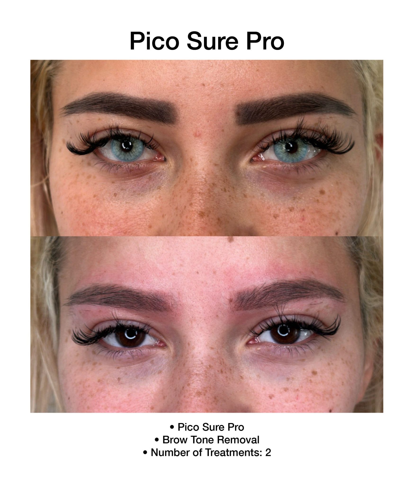 Improved skin clarity after PicoSure Pro therapy.