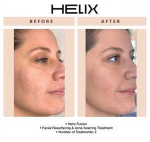 Side-by-side before and after Helix laser results demonstrating visible skin rejuvenation at Beauty Glam Studio in Florida.