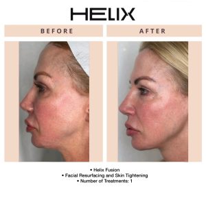 Before and after Helix laser treatment improving skin clarity and overall appearance at Beauty Glam Studio in Florida.