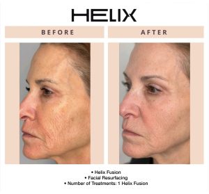Before and after Helix laser procedure showing smoother, healthier-looking skin at Beauty Glam Studio in Florida.