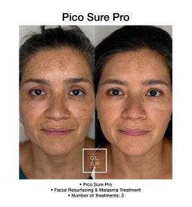 Reduction in pigmentation following PicoSure Pro laser treatment.