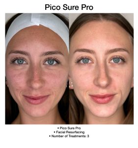Smoother skin texture achieved with PicoSure Pro laser therapy.