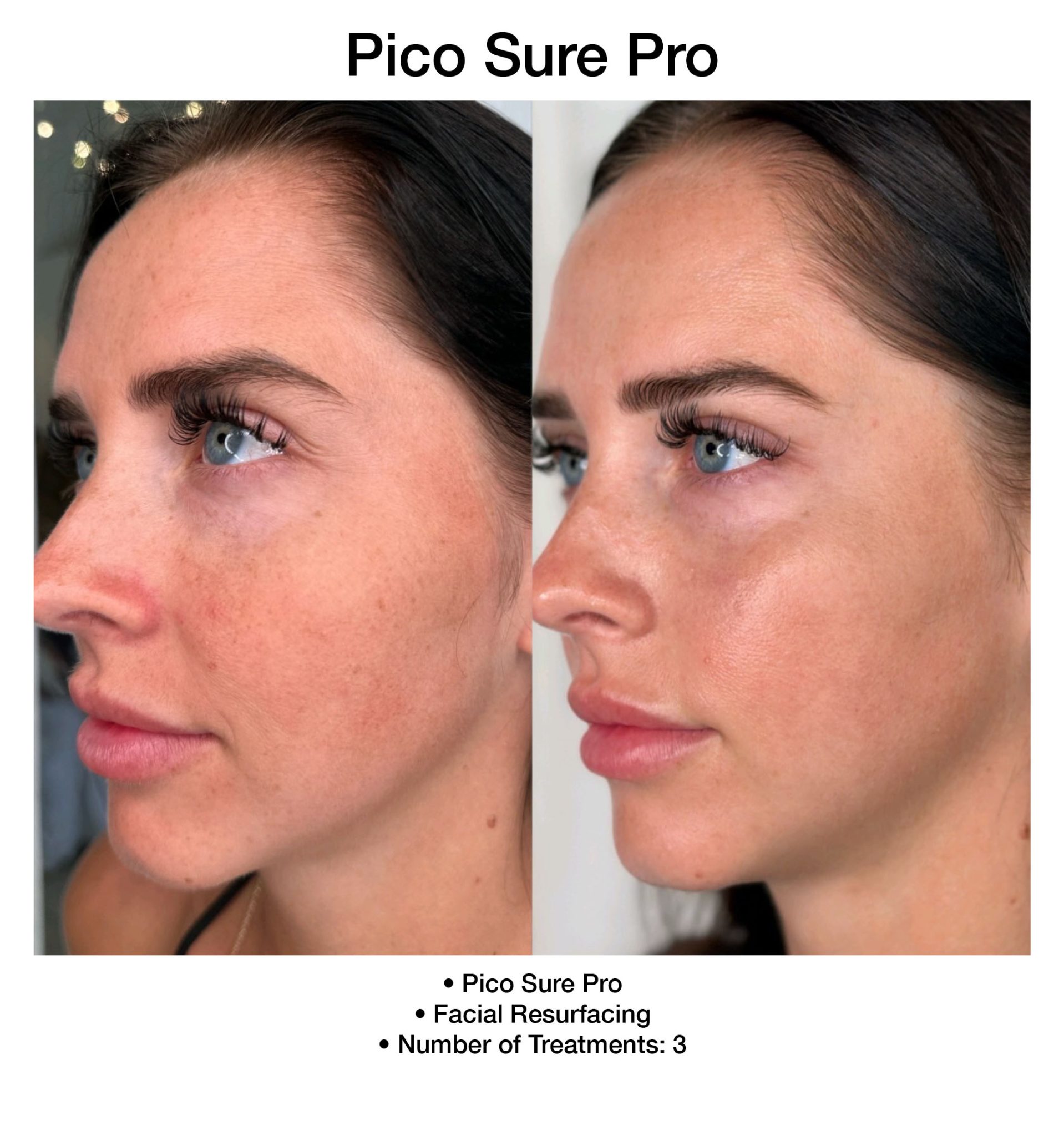 Visible skin rejuvenation after PicoSure Pro treatment.