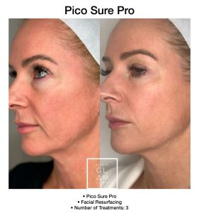 PicoSure Pro laser reducing pigmentation and uneven tone.