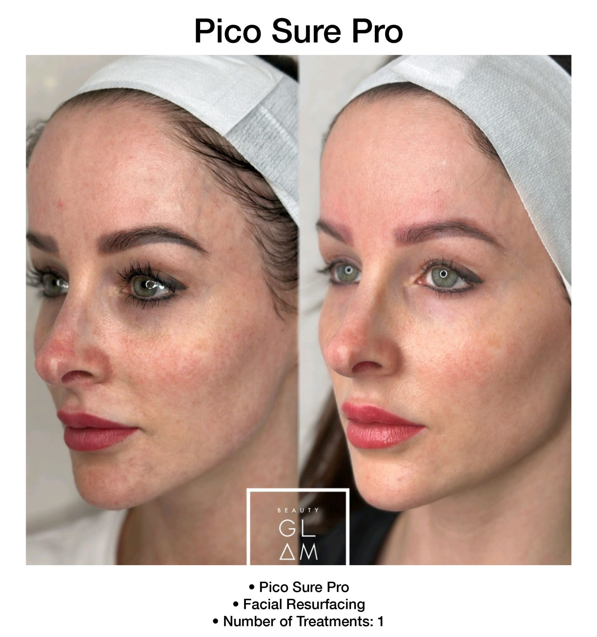 Skin improvement following PicoSure Pro laser treatment.