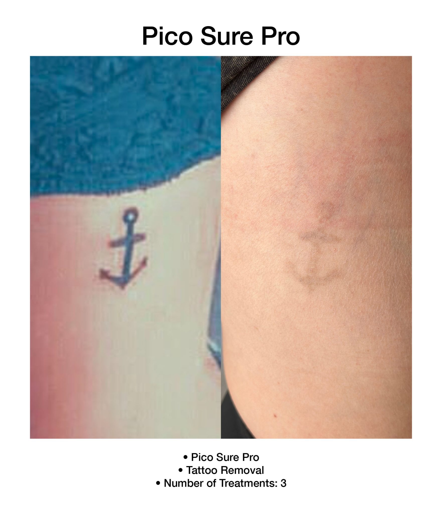 PicoSure Pro laser therapy targeting uneven pigmentation.