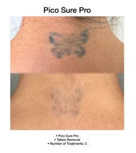 Before and after PicoSure Pro treatment improving skin texture.