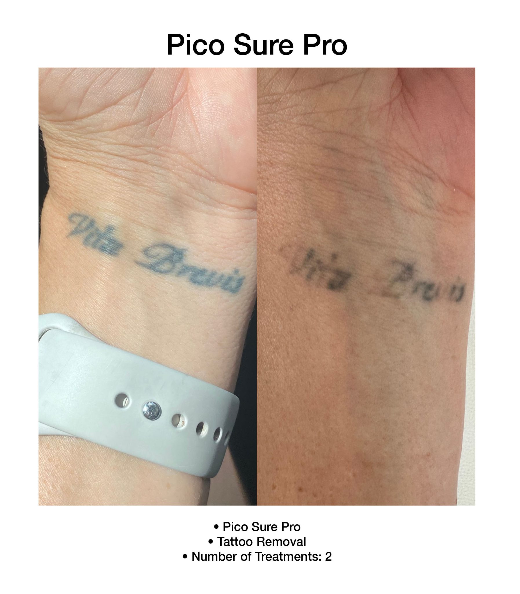 PicoSure Pro results showing clearer, brighter skin.